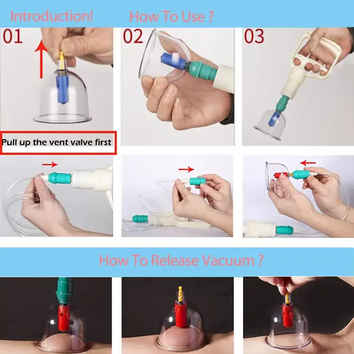Ensemble de thérapie par ventouses médecine chinoise physiothérapie