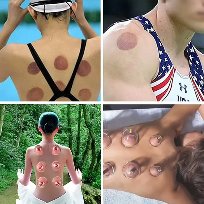 Ensemble de thérapie par ventouses sous vide